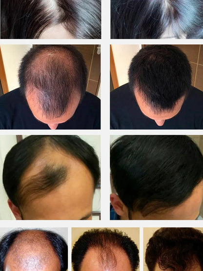 Fast Hair Growth Hair Growth Oil Effective Baldness Repair Hereditary Hair Loss Postpartum Hair Loss Seborrheic Hair Anti Loss